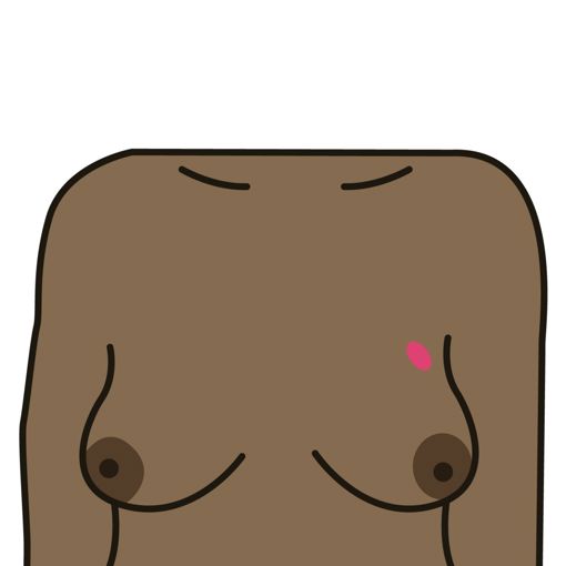 A lump or swelling in the breast, upper chest or armpit